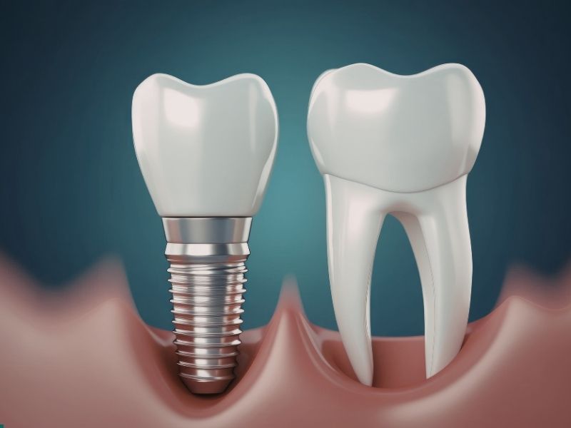 Dental Implant in Sharjah