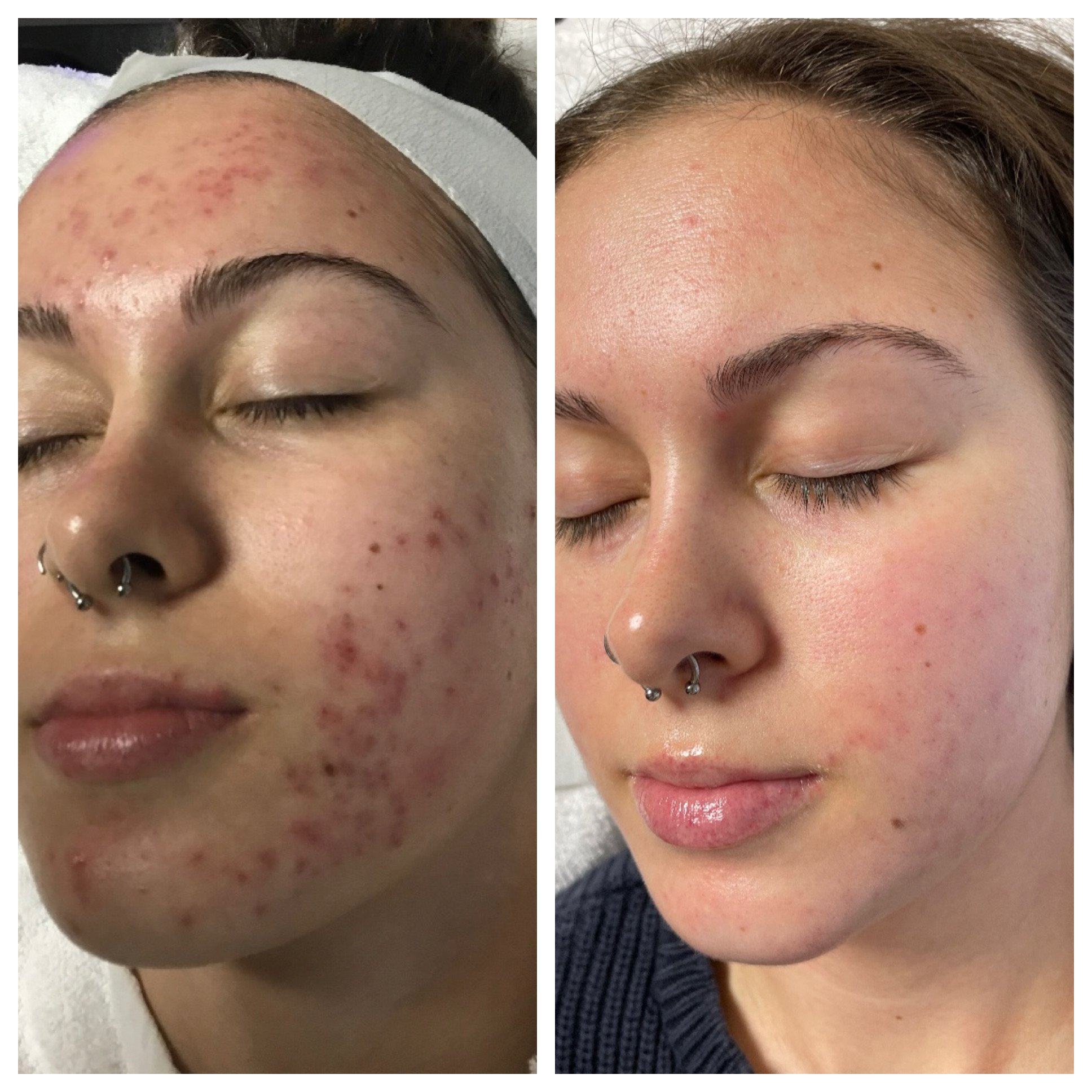 ACNE-CLINIC_B_A_13