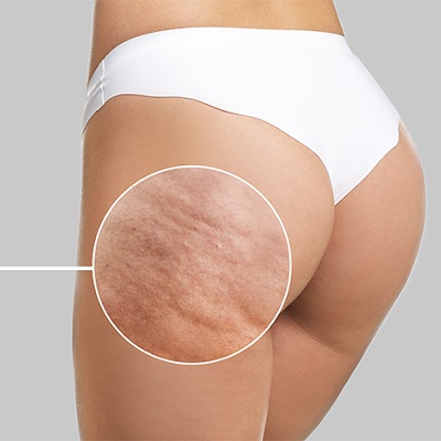 Cellulite-Removal-Treatment-in-Abu-Dhabi