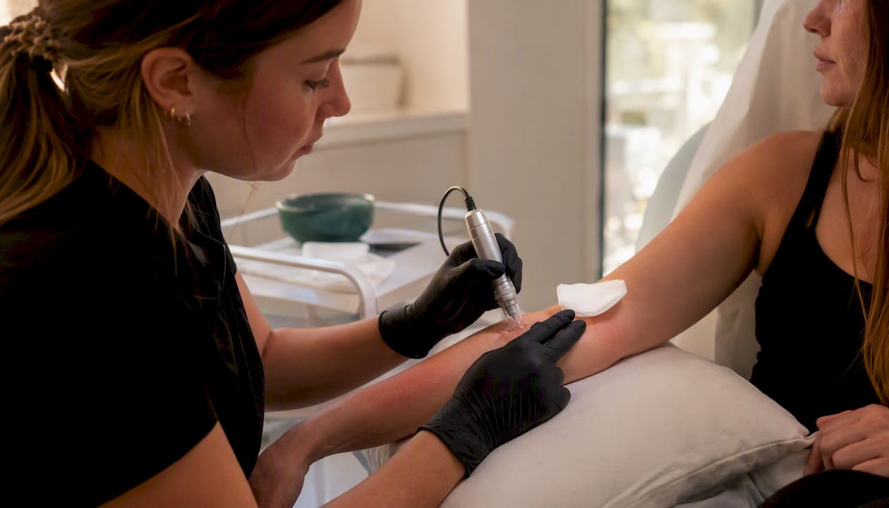 Microneedling treatment on patient's skin