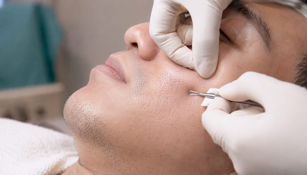 Manual deep pore extraction on male skin