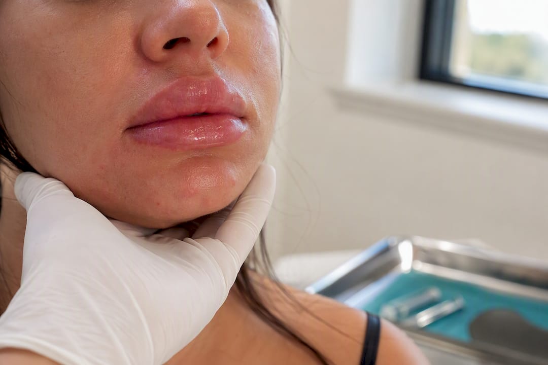 Swollen lips 48 hours after filler