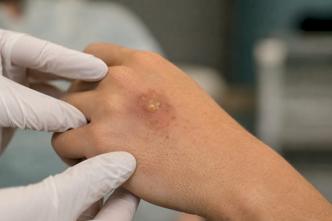 Close-up of skin blister burn from laser treatment